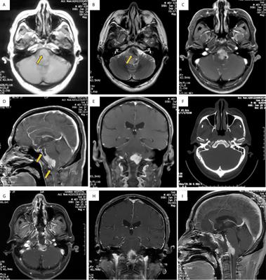 IgG4-Related Inflammatory Pseudotumor Involving the Clivus: A Case Report and Literature Review